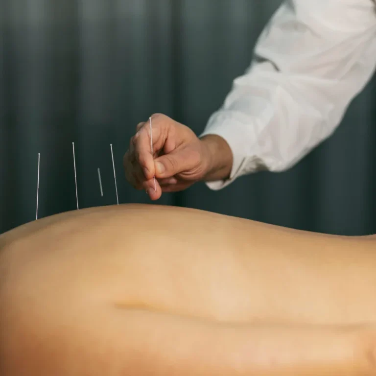 Close-up of acupuncture needles inserted into a person's back.